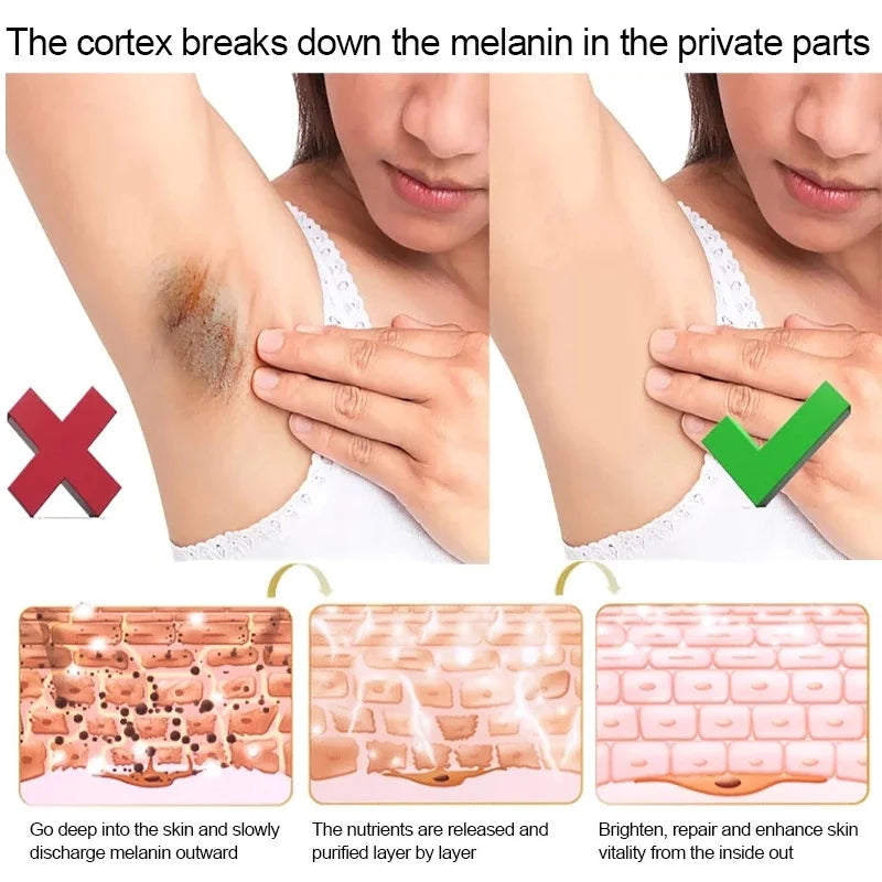 Whitening Cream Private Parts Underarm Bleaching Lotion Whiten Butt Knee Brighten Inner Thigh Intimate Parts Dark Remove Melanin