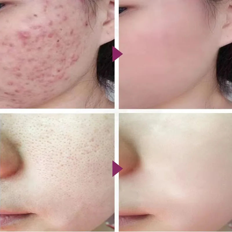 10% Lactic Acid HA Serum Face Peeling Brighten Solution Shrinking Pore Skin Care Tightening Facial Pore Minimizing Ordinary 30ML