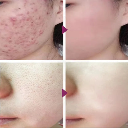 10% Lactic Acid HA Serum Face Peeling Brighten Solution Shrinking Pore Skin Care Tightening Facial Pore Minimizing Ordinary 30ML