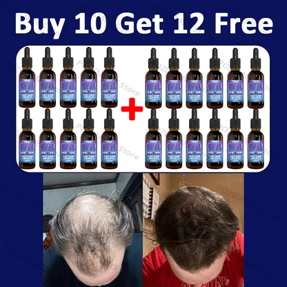 99% repurchase, more and more hair, say goodbye to baldness, hot selling product