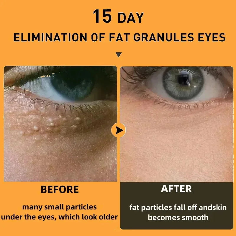 Fat Granules Removal Eye Cream Stick Anti-Puffiness Anti Inflammatory Eye Skin Care Reduce Dark Circles Repair Barrier Products